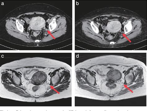 Figure 1 From A Case With Residual Obturator Lymph Node Resected Laparoscopically After Lateral