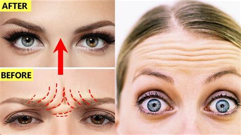 How To Reduce Forehead Wrinkles And Frown Lines Between Eyebrows