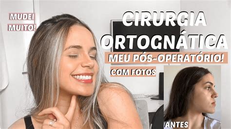 Tudo Sobre Minha Cirurgia Ortogn Tica Antes E Depois Da Cirurgia