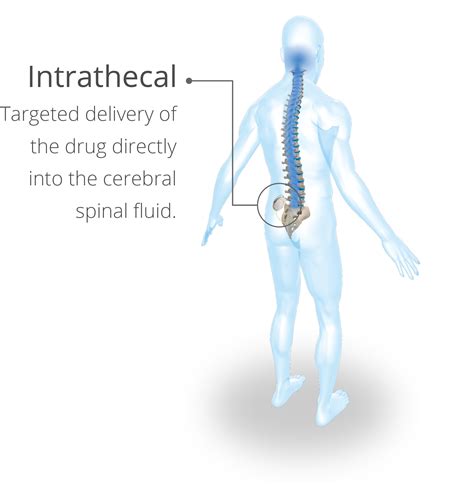 Intrathecal Injection