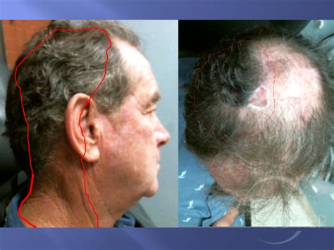 Scalp SCC Metastasis to Neck - Skin Cancer and Reconstructive Surgery Center