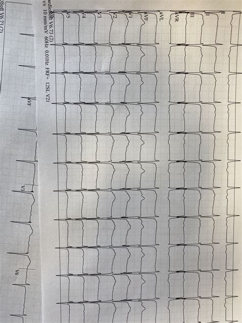 Roughly 70 year old male, plenty of pulmonary with some cardiac history
