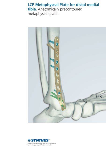 LCP Metaphyseal Plate For Distal Medial Tibia Osteosyntese