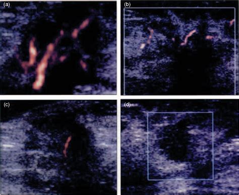 Figure 1 from Ultrasound diagnosis of breast cancer | Semantic Scholar