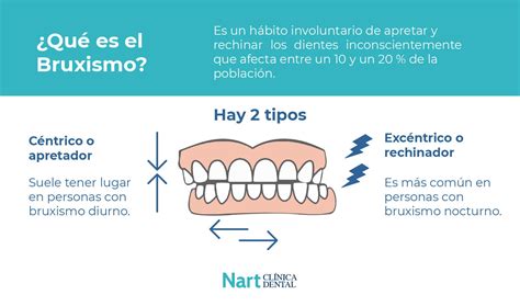 ¿tienes Bruxismo 3 Consejos Para Evitarlo Nart Clínica Dental