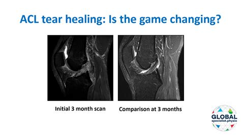 ACL tear healing without surgery: Is the game changing? | Global