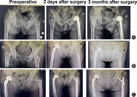 Validation Of The Nottingham Hip Fracture Score In Predicting