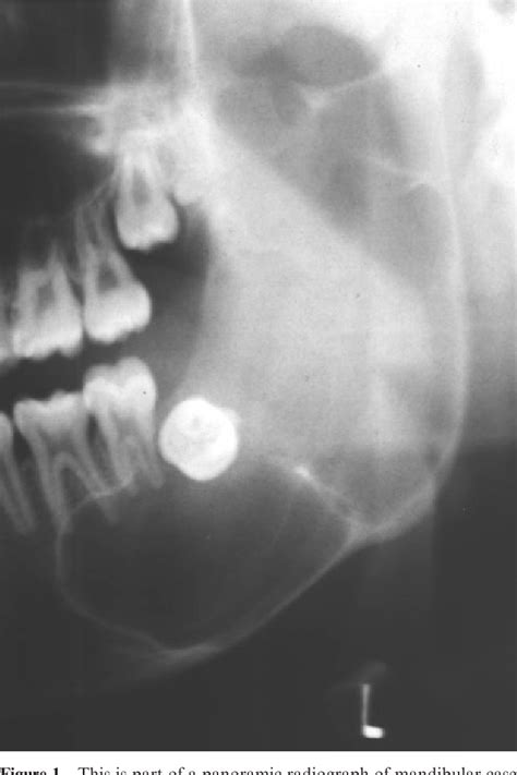 Figure 1 From Keratocystic Odontogenic Tumour In A Hong Kong Community