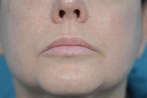 Lip Augmentation Before and After 04| Contoura