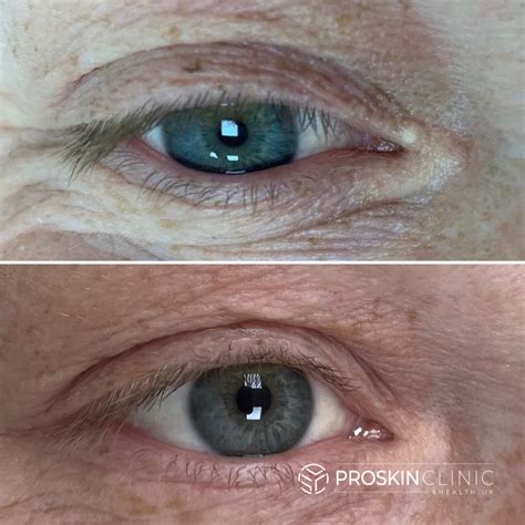 Remove Milia From Upper Eyelid