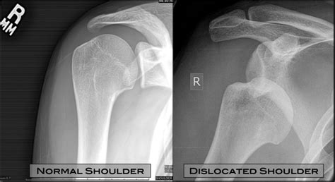 normal-versus-dislocated-shoulder-x-ray – Physio Sport & Spine Cheyenne ...