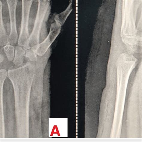 Postoperative Radiograph Of The Wrist Joint A Posteroanterior View Of