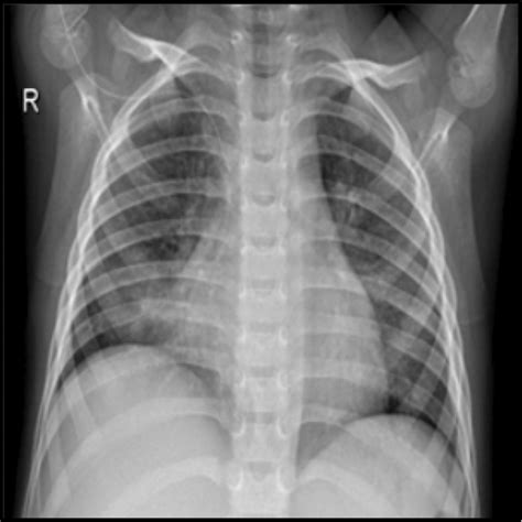 Chest X‐ray radiograph with Pneumonia | Download Scientific Diagram