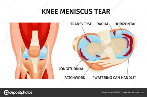 Knee Meniscus Tear Anatomy Diagram Realistic Infographics White ...