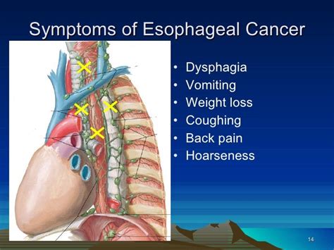 11 esophageal cancer