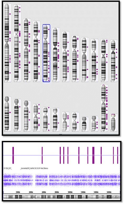 Chromosomal microarray analysis. Showing both the karyotype homozygous ...