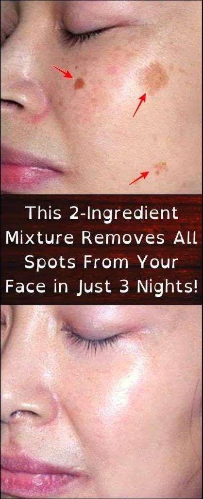 Amazing This 2 Ingredient Remedy Removes All Spots From Your Face In