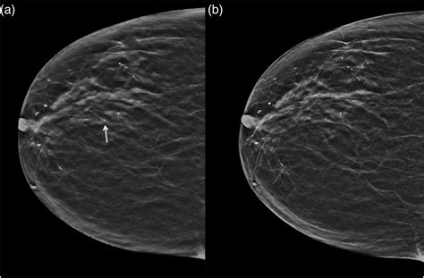 Digital Breast Tomosynthesis Image Acquisition Principles And