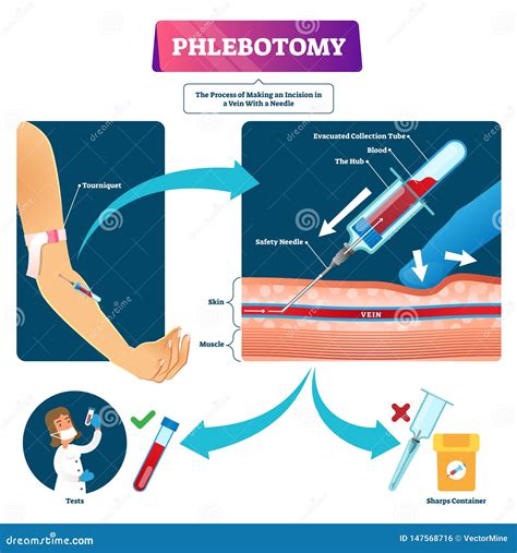 Phlebotomy Vector Illustration Labeled Veins Blood Samples Process