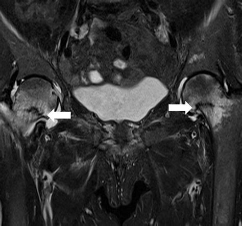 Hip Bursitis MRI