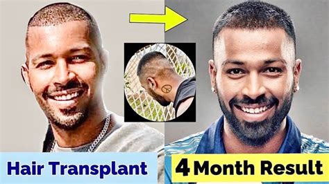 Hardik Pandya Hair Transplant - SULE HAIR TRANSPLANT