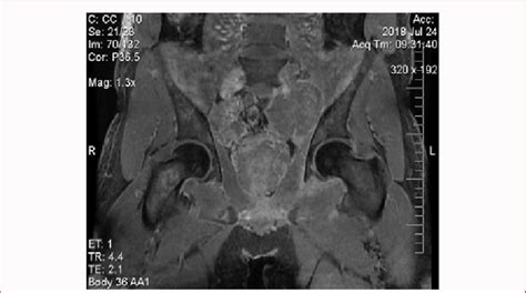 Multiple Bilateral Pelvic Adenopathies Revealed By The Patients Pelvic