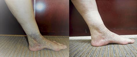 Sclerotherapy Spider Vein Treatment Removal To Improve Your Legs