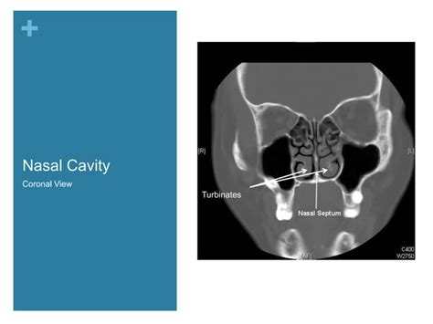 Nasal Cavity And Paranasal Sinuses Radiologic Anatomy