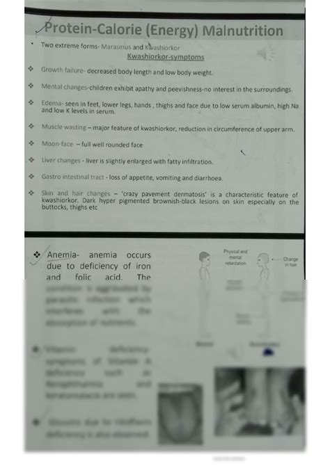 Protein Calorie Malnutrition Explanation at Joanne Tindall blog