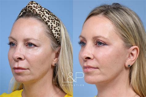 Laser Skin Resurfacing Trl Case L P Aesthetics