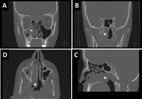 Antrochoanal Polyp Updated Clinical Approach Histology