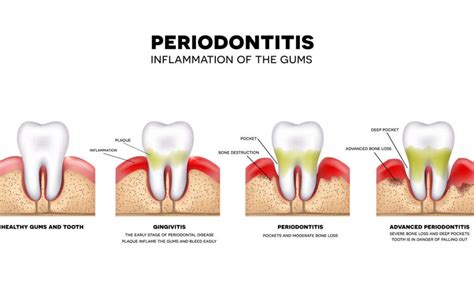 Parodontologia Studio Dentistico Raniolo Vicenza