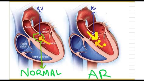 Aortic Regurgitation The Basics Dr S Parthasarathy Md Dnb Phd