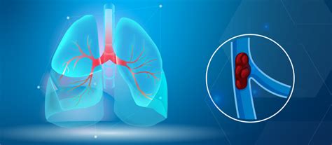 Pulmonary Embolism | Washington Vascular