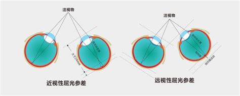 揭秘屈光参差及矫正屈光参差的方法 知乎