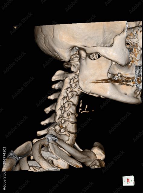 CT Scan cervical spine 3 D render and X-ray C-spine finding Reverse ...