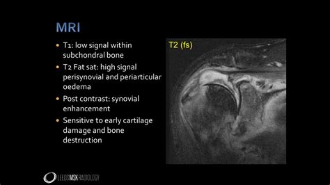 Imaging Findings Of Septic Arthritis Tenosynovitis Bursitis YouTube