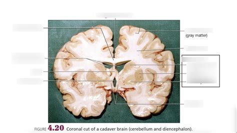 Coronal Cut Cut Diagram Quizlet