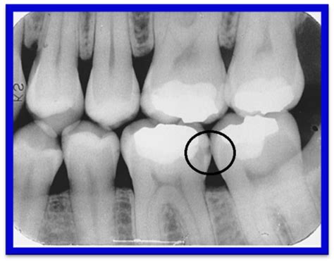 Radiology Dental Caries Flashcards Quizlet