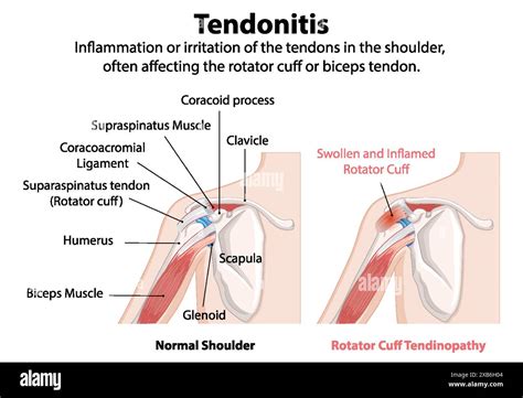 Illustration Of Normal And Inflamed Shoulder Tendons Stock Vector Image