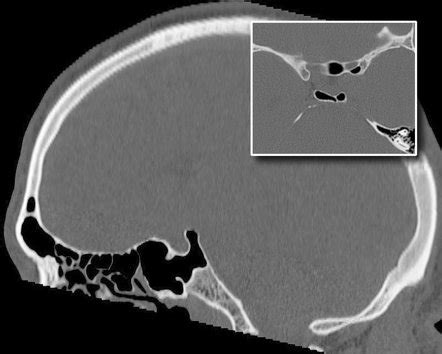 Pneumatised dorsum sella | Radiology Reference Article | Radiopaedia.org