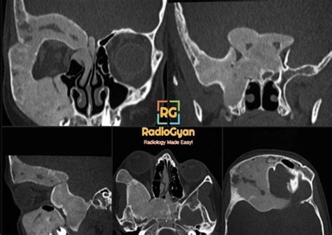 Fibrous Dysplasia | Radiology Case | - RadioGyan