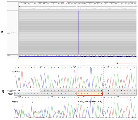 Jpm Free Full Text A Novel Pax Frameshift Mutation Identified In A