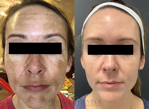 Chemical Peel In The Woodlands Conroe And Spring Tx The Gill Center