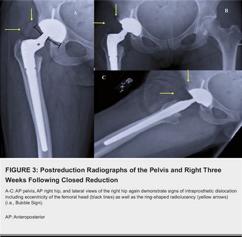 Figure From A Missed Diagnosis Of Intraprosthetic Dislocation In A