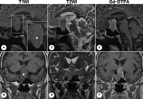 Frontiers Case Report Paraganglioma In The Sellar Region