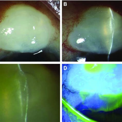 Leaking bleb 13.5 years following trabeculectomy. Clinical slit-lamp... | Download Scientific ...