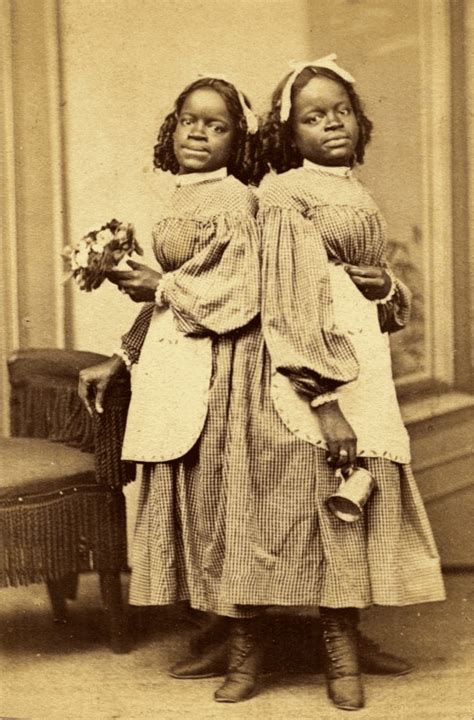 Famous Conjoined Twins In History Discover Walks Blog