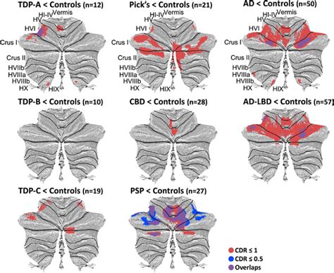 Voxelbased Morphometry Analyses Showing Regions Of Decreased