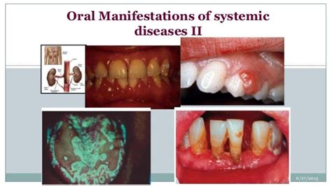 Oral Manifestation Of Systemic Disease